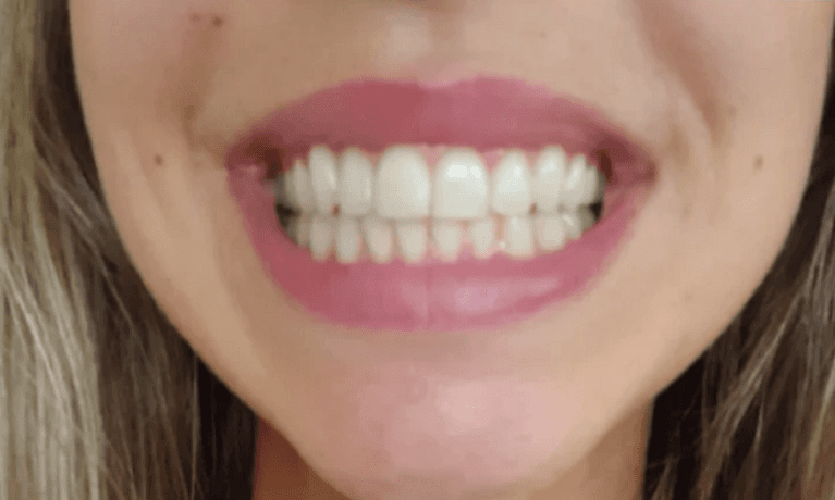 Aligners-After-Image