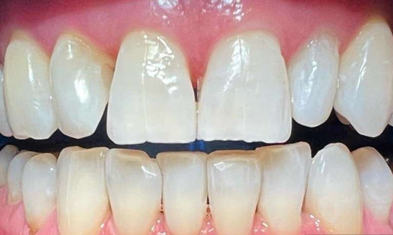 Teeth-Whitening-After-Image