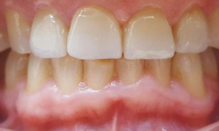 Veneers-After-Image