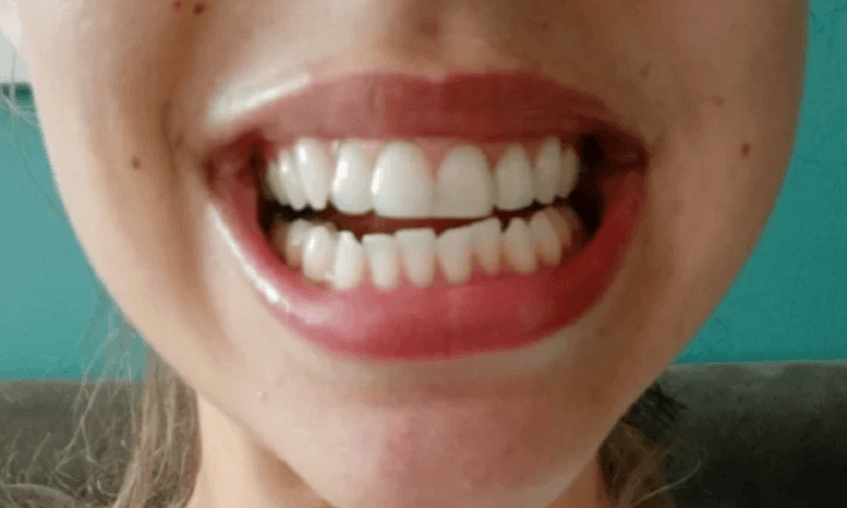 Aligners-Before-Image