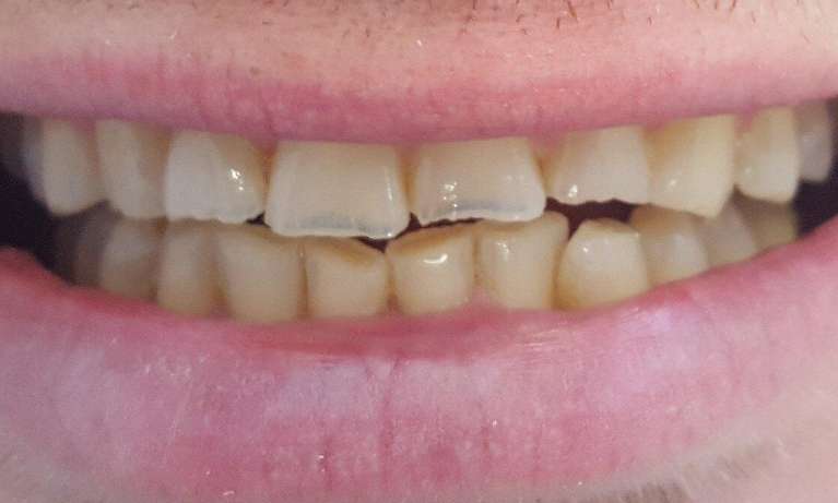 Veneers-Before-Image